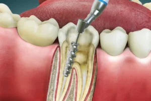 Root Canal Treatment in Bangalore