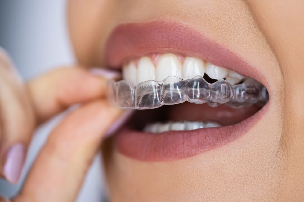 Confused between braces and aligners? Learn the pros and cons of each to find the best fit for your dental needs and lifestyle.