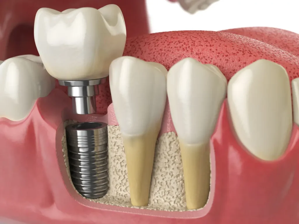 Tooth_Replacement_in_Bangalore