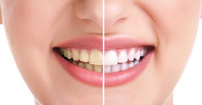 Top 5 Teeth Whitening Treatments in Bangalore