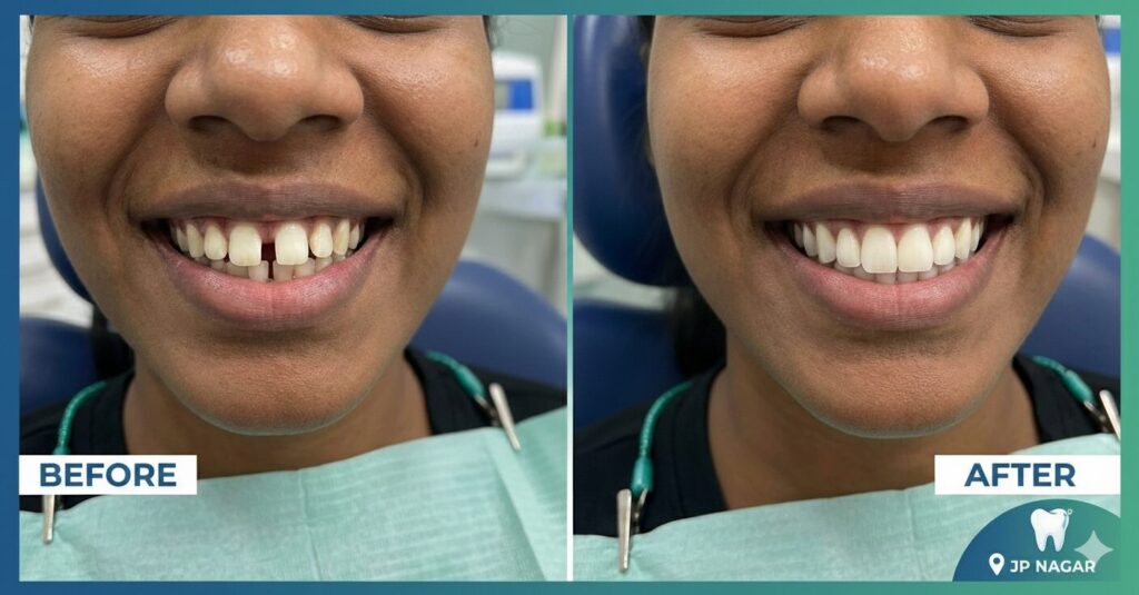 Teeth Gap Treatment at Ivory Dental World JP Nagar