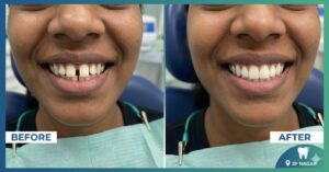 Teeth Gap Treatment at Ivory Dental World JP Nagar