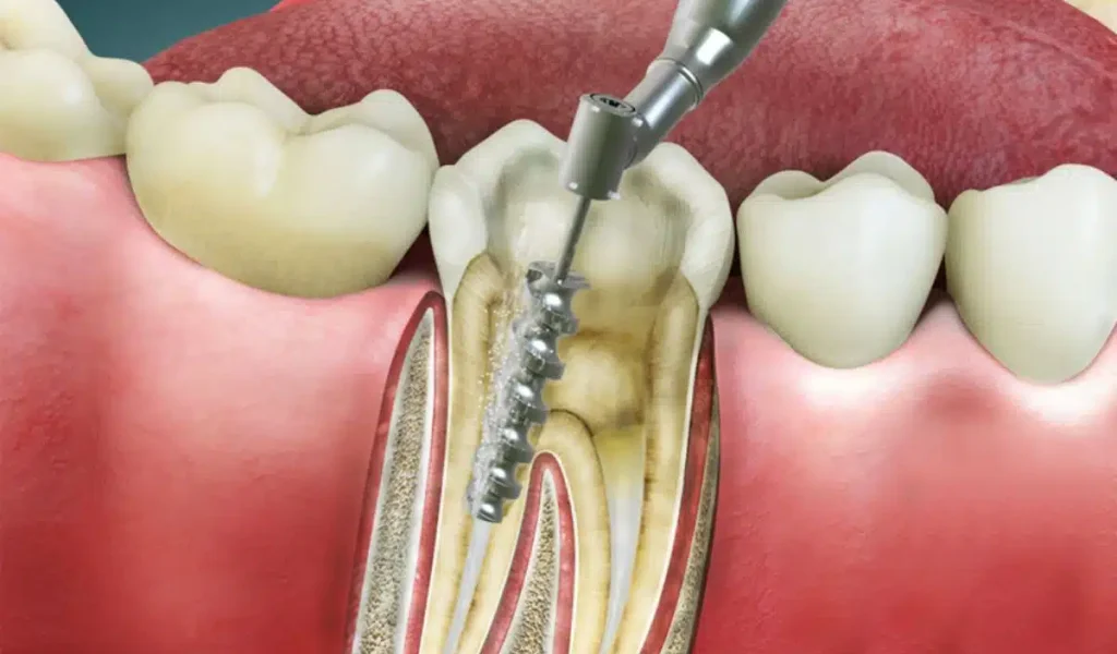 Root Canal Treatment in Bangalore