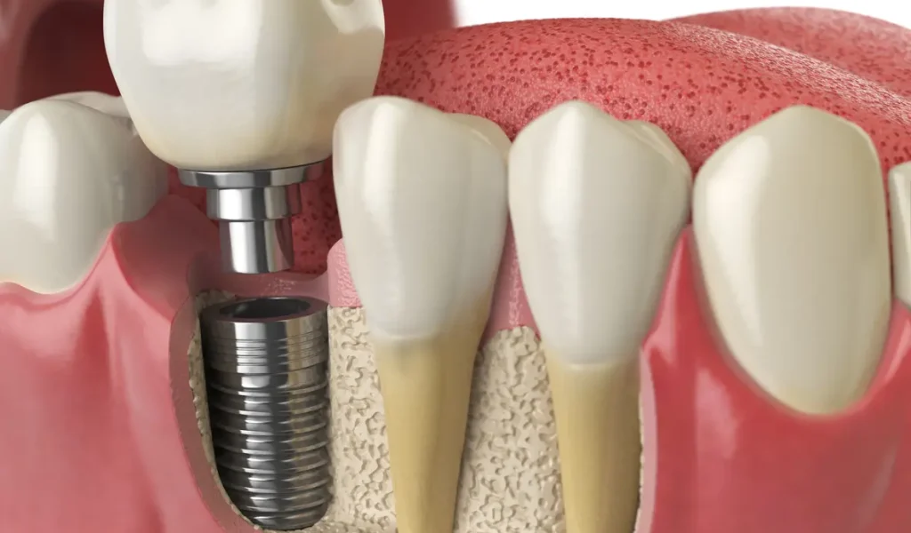 Tooth_Replacement_in_Bangalore