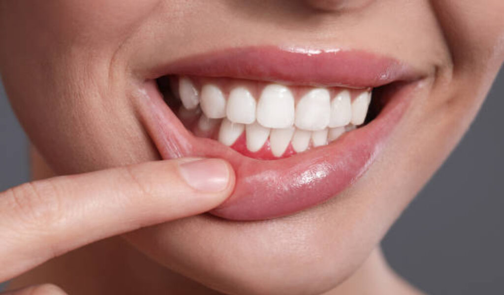 Swollen gums warning sign showing red and inflamed gum tissue