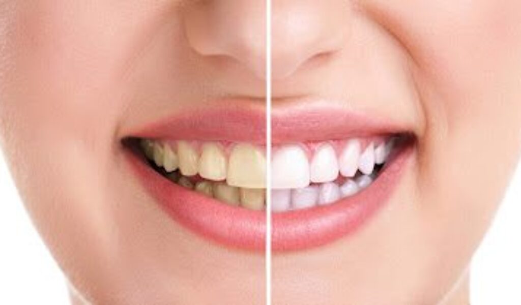 Top 5 Teeth Whitening Treatments in Bangalore